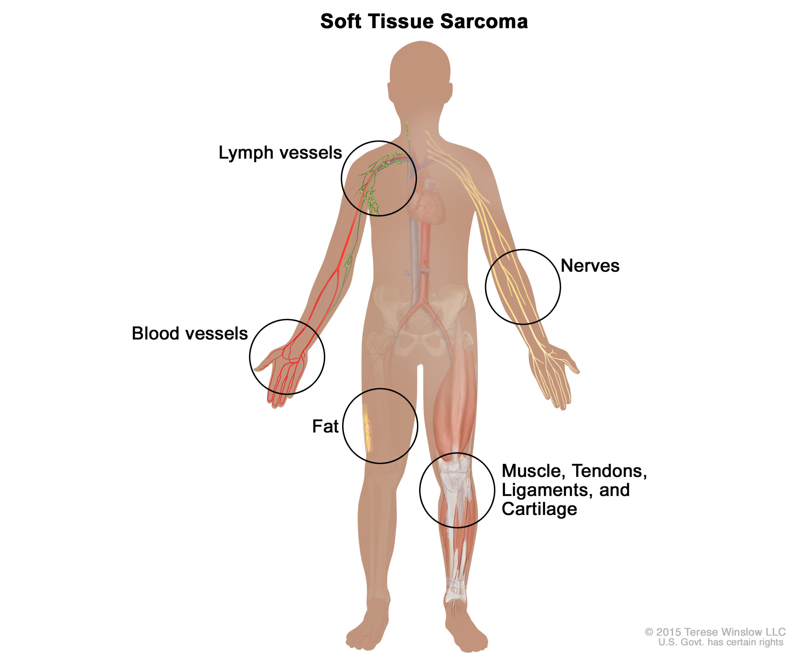 Soft tissue sarcoma common places for development